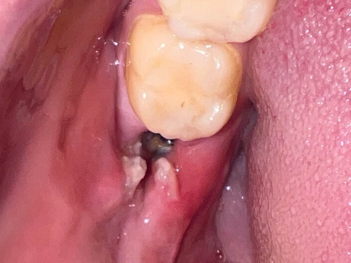 Альвеолит после удаления зуба: виды и лечение