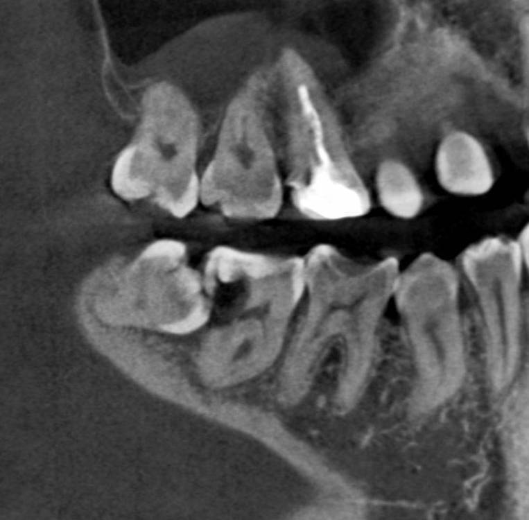 Снимок осложнение от 8го.JPG