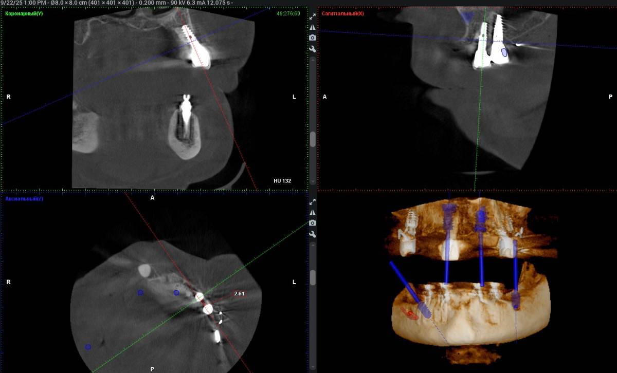 SEUTA_PRE_OP_MAX.jpg.2fdbef415d5cb70b053bcc8614ef4112.jpg
