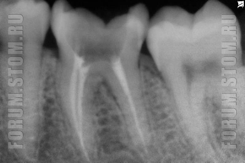 Болит зуб после пломбирования каналов — 5 причин боли