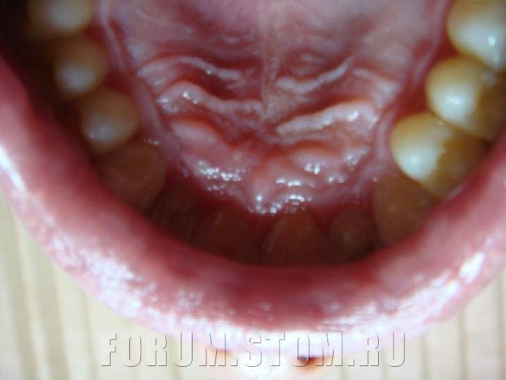 Воспаление неба около зуба: причины и лечение